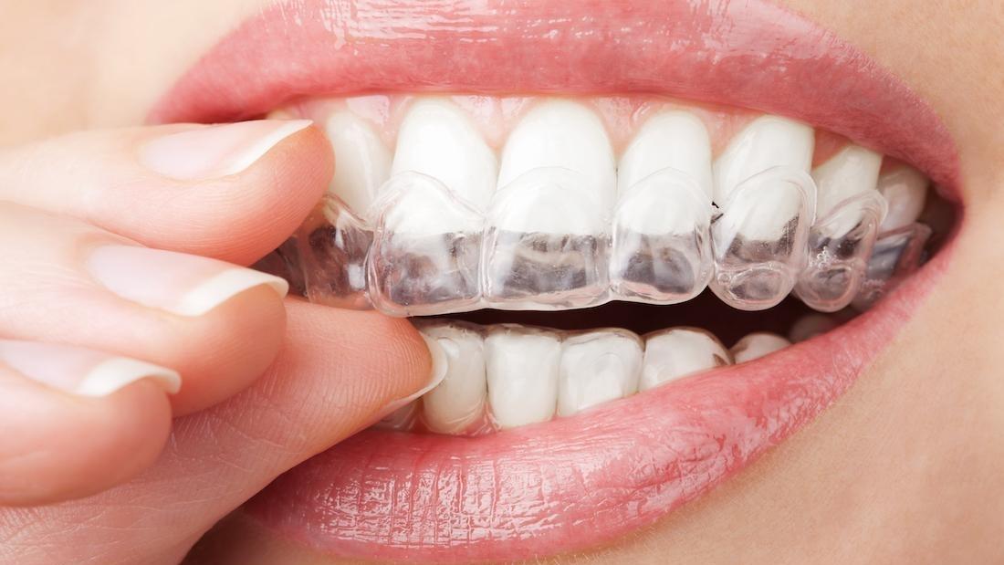 The Main Differences between Invisalign and Braces Jonesboro AR