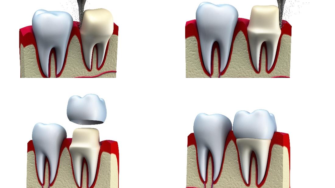Dental Crowns & Veneers Jonesboro AR Cosmetic Dentist Blog